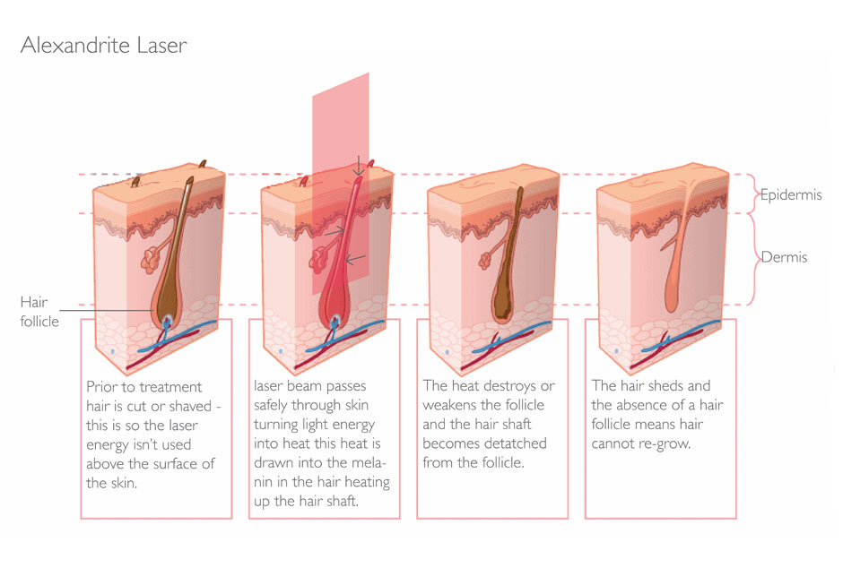 Laser Hair Removal - Parfaire Clinic